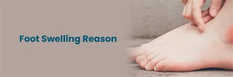 Foot Swelling: Causes, Symptoms, and Treatment Options