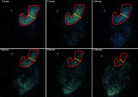 Clinical assessment of gastric emptying and sensory function utilizing gamma scintigraphy ...