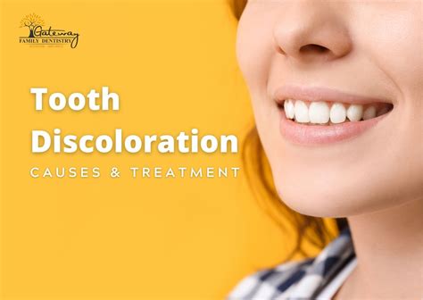 Tooth Discoloration - Causes, Prevention & Solutions | Gateway Dentistry, TN