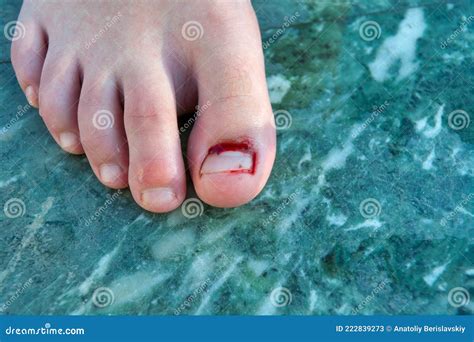 Foot Nail Injury