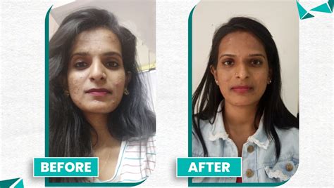 Acne Scar Treatment in Chennai | Laser Scar Removal Cost, Results