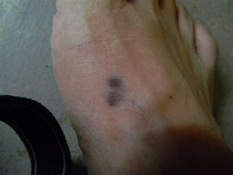 House Centipede Bite Marks - hhousehrh