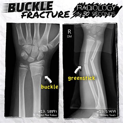Buckle fracture on Vimeo