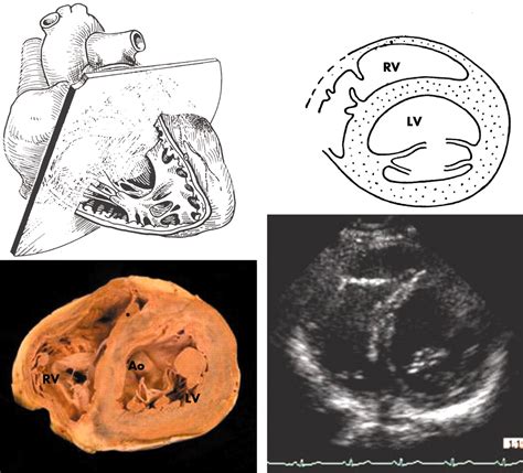Anatomy, echocardiography, and normal right ventricular dimensions | Heart