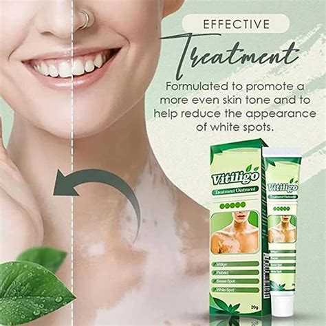 Buy White Tag Treatment Moisturizing Cream,Pigment Melanin Plaster ...