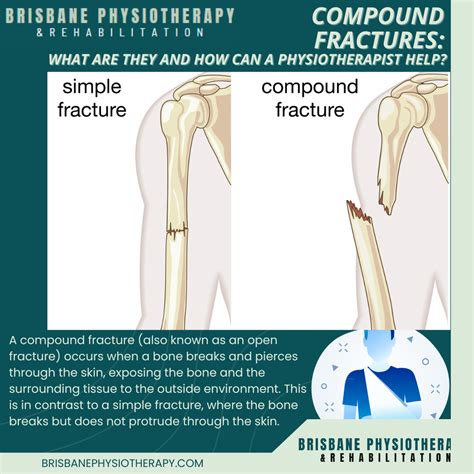 Compound Fractures and How Physiotherapy Can Help - Brisbane ...