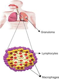 Tuberculosis cases surged for the first time in many years - GS SCORE