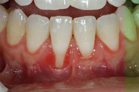 Gum Grafting Birmingham AL