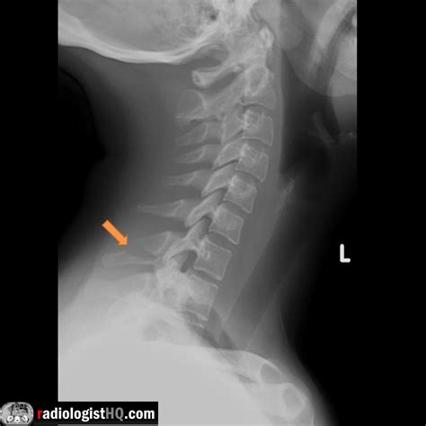 Clay shoveler's fracture on x-ray : r/Radiology
