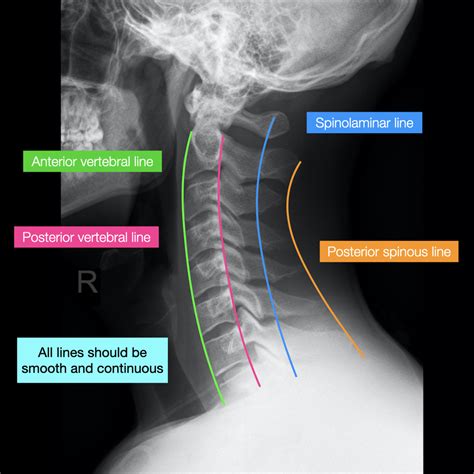 Normal Cervical Spine Radiographs Image Radiopaediaorg Cervical Spine
