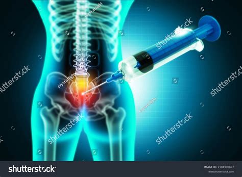 Image result for Lumbar Disc Injection