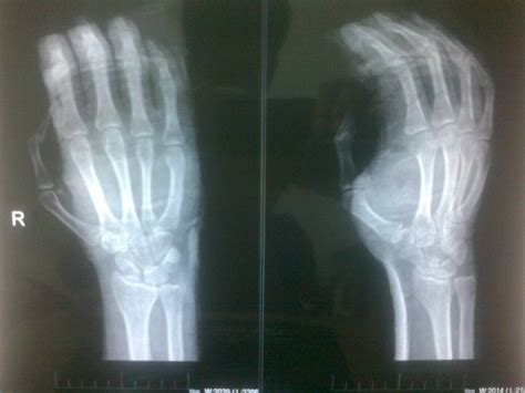 右手第5掌骨骨折 怎么办？ 需要做手术吗？不做手术多久可以好？_百度知道