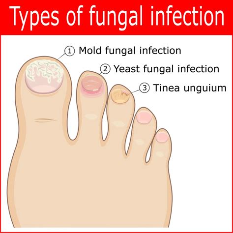 Toenail Fungus Treatment & Lasting Antifungal Care