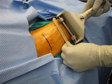 Split Thickness Skin Graft (STSG) Zimmer Dermatome Settings - Clinical Case Example | Iowa Head ...