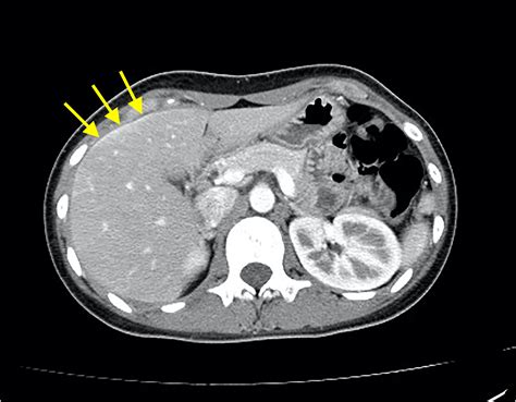 Fitz-Hugh Curtis syndrome - The American Journal of the Medical Sciences