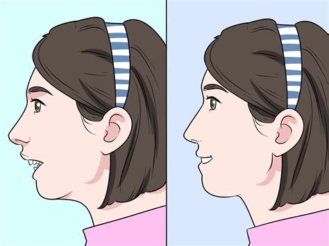 How to Fix an Overbite: 9 Steps (with Pictures) - wikiHow