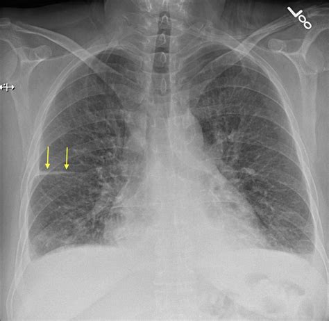 Pulmonary Edema Chf Chest X Ray