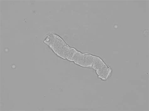 Waxy cast | CellWiki