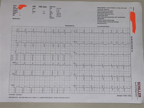 LAFB + RBBB + AF + Right Ventricle Hypertrophy : r/ECG