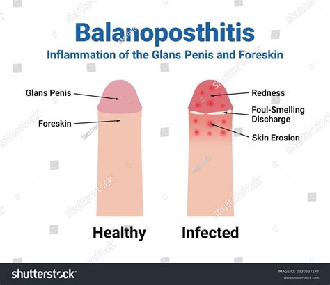Balanoposthitis Symptoms Medical Vector Illustration Stock Vector ...