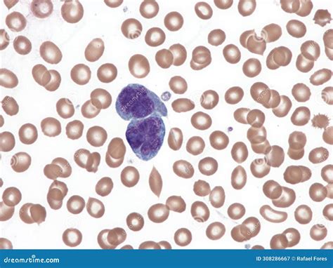 Anaplastic Large-cell Lymphoma. Peripheral Blood. Stock Image - Image of rare, blood: 308286667