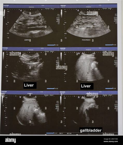 Ultrasonography of the upper abdomen with visualized portions of the ...