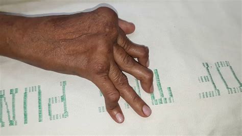 Image result for Hand Dysfunction