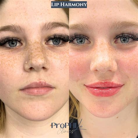 Lip volumising before & after photos