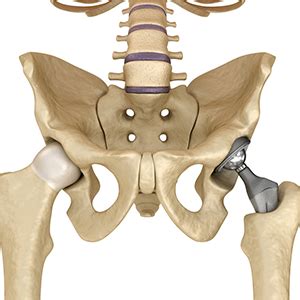 Hip Socket Surgery Hospital In Vijayawada | Pelvic And Acetabular Surgery