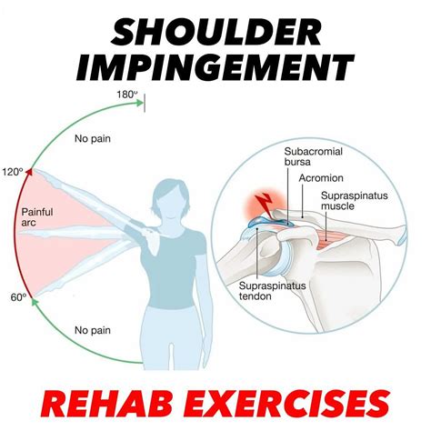 Dr. Tom Walters, DPT, OCS | 💥𝐒𝐮𝐛𝐚𝐜𝐫𝐨𝐦𝐢𝐚𝐥 𝐏𝐚𝐢𝐧💥 —— 📚Shoulder impingement is an older diagnosis ...