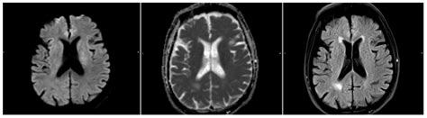 An Automatic DWI/FLAIR Mismatch Assessment of Stroke Patients