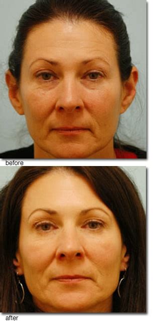 Image result for Botox Tutorial