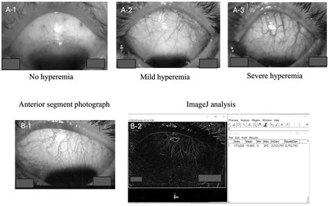 Impact of Preoperative Conjunctival Vascular Area on Surgical Outcomes ...