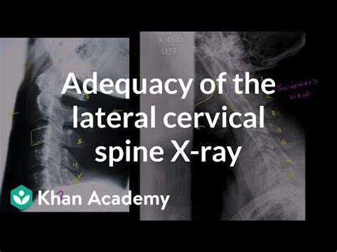 Adequacy of the lateral cervical spine X-ray Video Lecture - Class 1