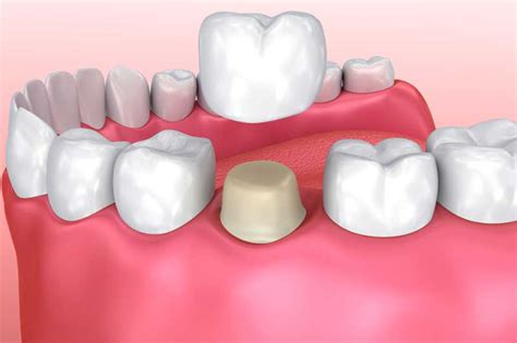 Recovery From Dental Crown Procedure: Pain, Healing Time, and Risks