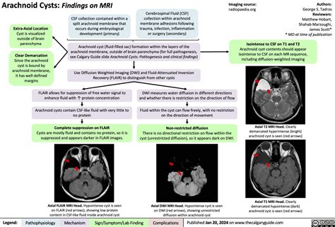 Arachnoid Cysts MRI Findings | Calgary GuideCalgary Guide