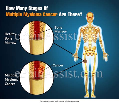 How Many Stages Of Multiple Myeloma Cancer Are There?