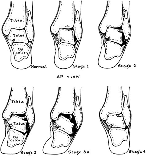 Osteochondritis Dissecans of the Talus - Clinics in Sports Medicine