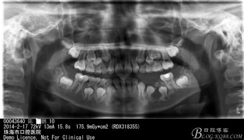 下颌骨含牙囊肿一例-杨钒的博客-KQ88口腔博客