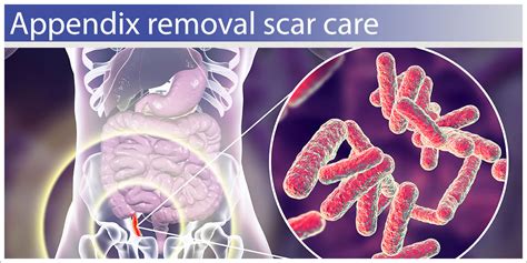 Image result for Appendix Surgery Scar