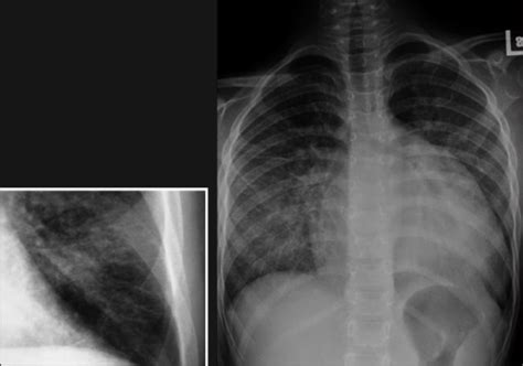 Prognosis Gagal Jantung - Alomedika