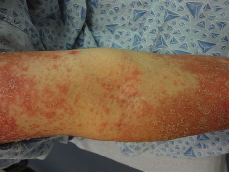 Pityriasis rubra pilaris
