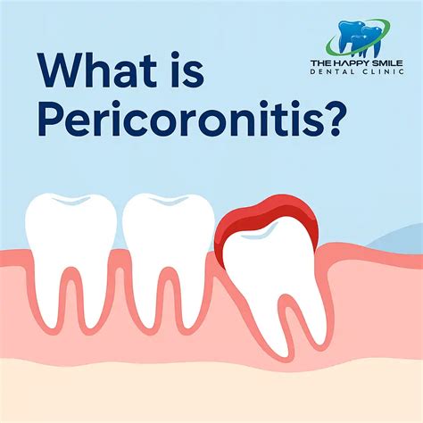 醴 Pericoronitis Treatment for Wisdom Tooth | The Happy Smile Dental Clinic