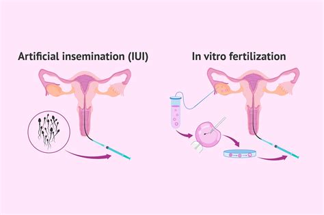 IVF Vs. Artificial Insemination: Key Differences Explained