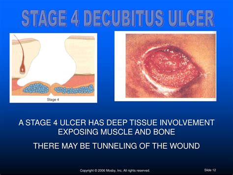 PPT - Decubitus Ulcers: Causes, Stages, and Treatments PowerPoint ...