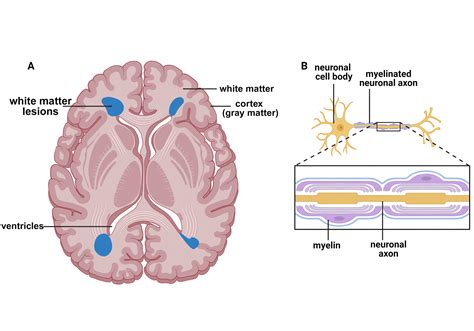 What is the link between white matter lesions and neurodegeneration?
