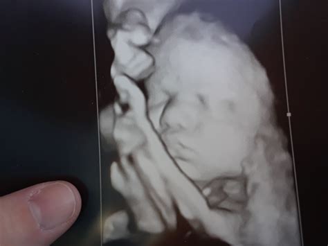 Down Syndrome Baby Ultrasound