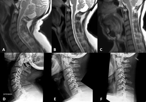 Clinical feasibility of 2D dynamic sagittal HASTE flexion-extension imaging of the cervical ...