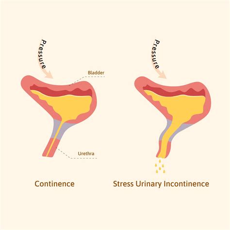 Stress And Bladder Control