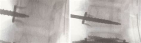 Use of electronic conductivity devices effectively reduces radiation ...